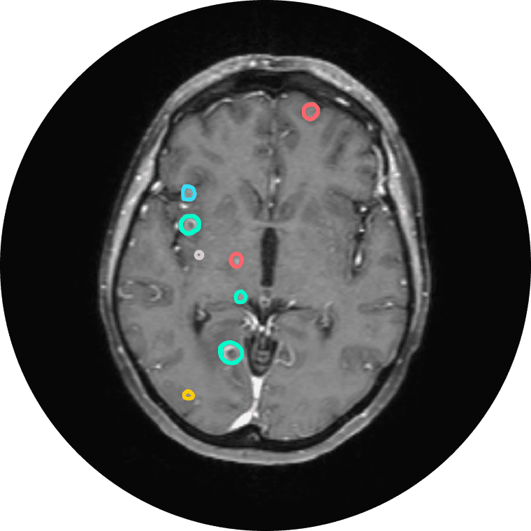 Brain Metastasis