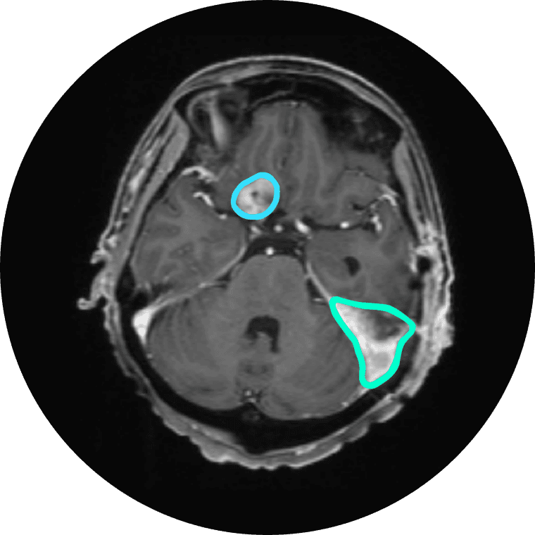 Meningioma