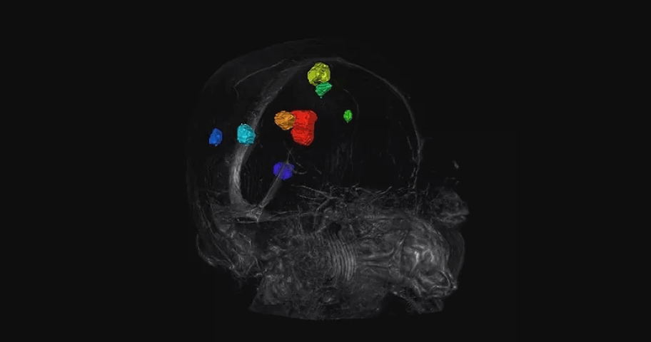 AI Came, AI Saw, AI Conquered: How Vysioneer Improves Precision Radiation Therapy