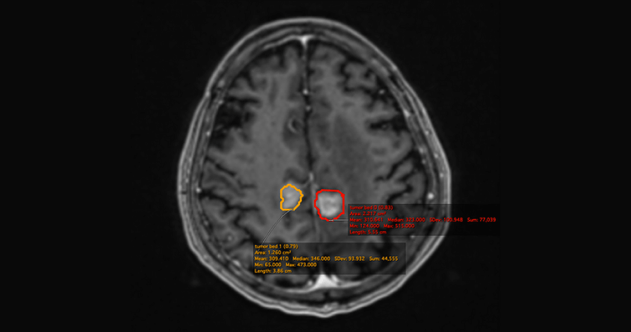 Vysioneer to Collaborate with National Taiwan University Hospital to Bring a First-ever AI-based Auto Contouring System to Brain Tumor Radiosurgery