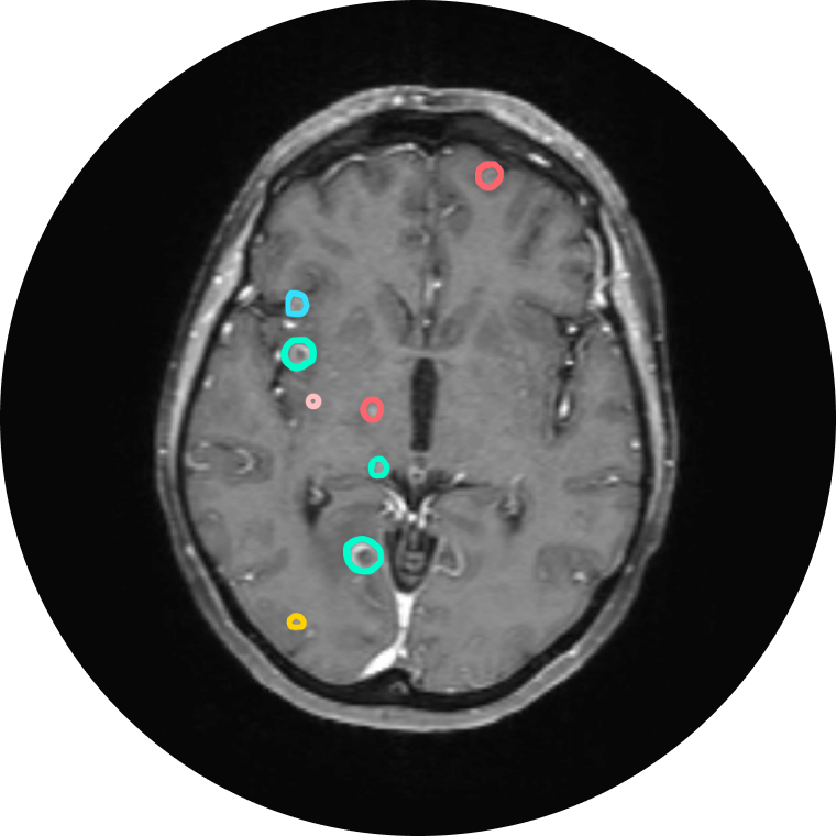 Brain Metastasis