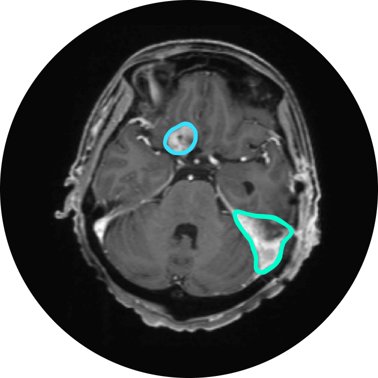 Meningioma