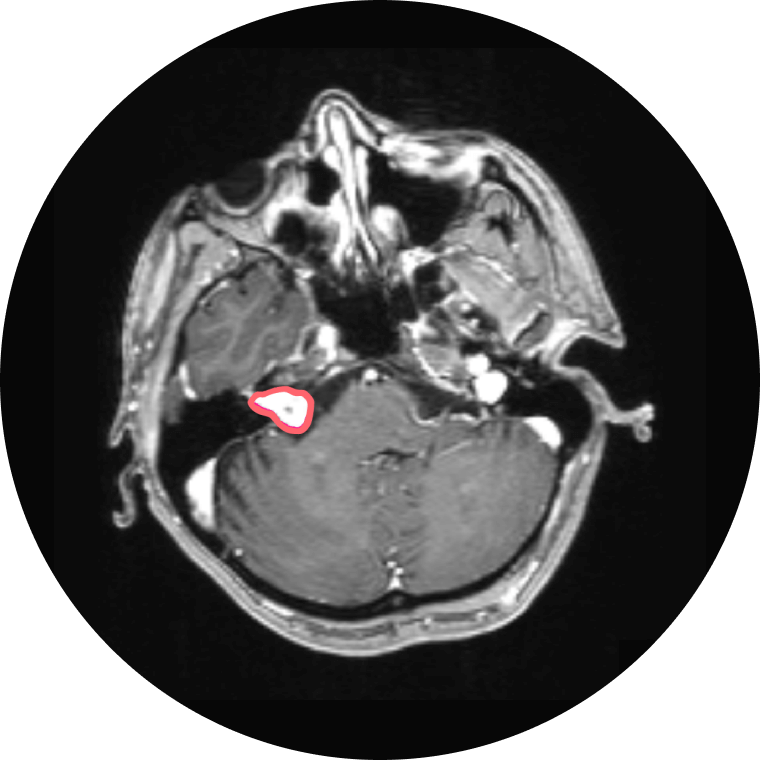 Acoustic Neuroma